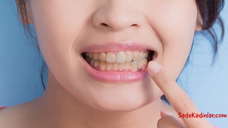 Dişlerdeki Sarı Lekeler Nasıl Önlenir?