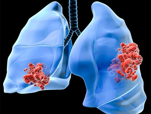Akciğer Kanseri'nin En Önemli Belirtileri Nelerdir?