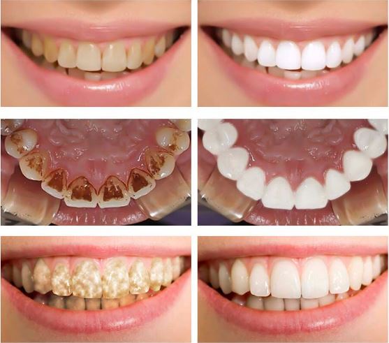 Diş Lekelerinden Nasıl Kurtulunur